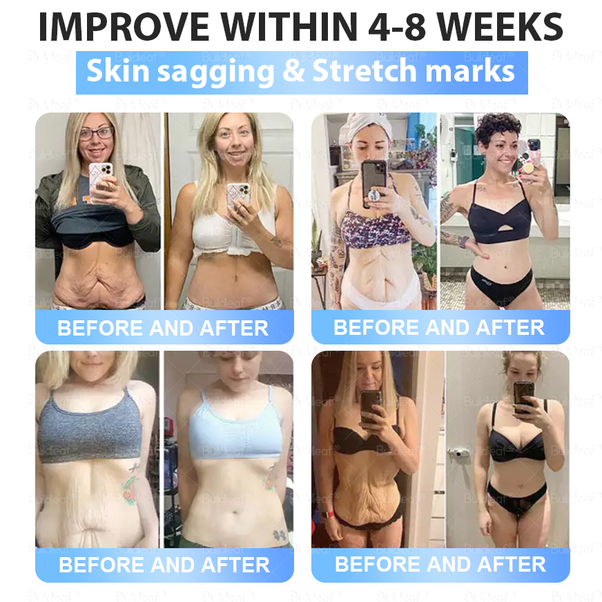 Official FDA Store·𝐁𝐮𝐢𝐥𝗱𝐋𝐞𝐚𝐟®𝐒𝐥𝐢𝐦 & 𝐅𝐢𝐫𝐦 𝐍𝐚𝐧𝐨 𝐌𝐢𝐜𝐫𝐨𝐧𝐞𝐞𝐝𝐥𝐞 𝐏𝐚𝐭𝐜𝐡 𝐰𝐢𝐭𝐡 𝐌𝐨𝐫𝐢𝐧𝐠𝐚, 𝐎𝐦𝐞𝐠𝐚-𝟑, 𝐂𝐨𝐥𝐥𝐚𝐠𝐞𝐧 𝐏𝐞𝐩𝐭𝐢𝐝𝐞𝐬, 𝐍𝐀𝐃 & 𝐍𝐌𝐍 𝐟𝐨𝐫 𝐎𝐛𝐞𝐬𝐢𝐭𝐲, 𝐂𝐚𝐫𝐝𝐢𝐨𝐯𝐚𝐬𝐜𝐮𝐥𝐚𝐫 𝐃𝐢𝐬𝐞𝐚𝐬𝐞, 𝐃𝐢𝐚𝐛𝐞𝐭𝐞𝐬, 𝐒𝐥𝐞𝐞𝐩 𝐀𝐩𝐧𝐞𝐚, 𝐉𝐨𝐢𝐧𝐭 𝐏𝐫𝐨𝐛𝐥𝐞𝐦𝐬, 𝐒𝐤𝐢𝐧 𝐅𝐢𝐫𝐦𝐢𝐧𝐠, 𝐀𝐧𝐭𝐢-𝐀𝐠𝐢𝐧𝐠, 𝐚𝐧𝐝 𝐌𝐨𝐫𝐞